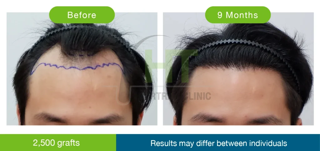 รีวิวปลูกผมผู้ชาย 9 เดือน