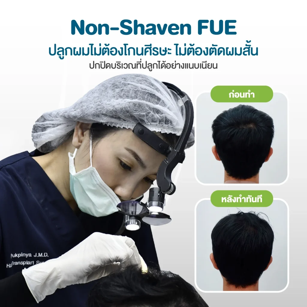 Non-Shaven FUE ปลูกผมไม่ต้องโกนศีรษะ