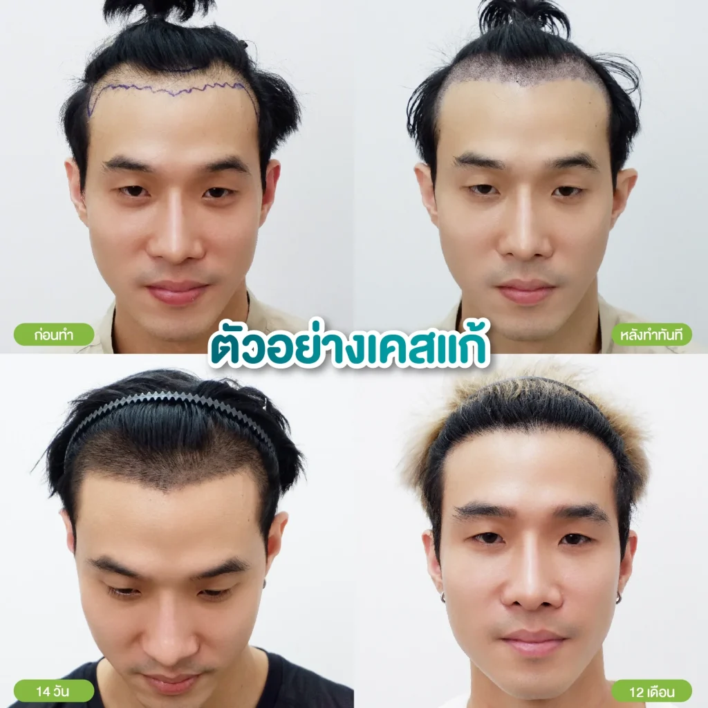 ปลูกผมแก้ Hairtran Clinic
