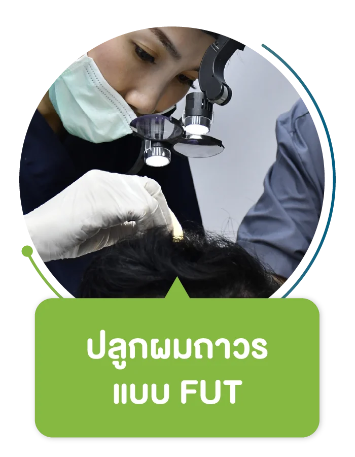 ปลูกผมถาวรแบบ FUT