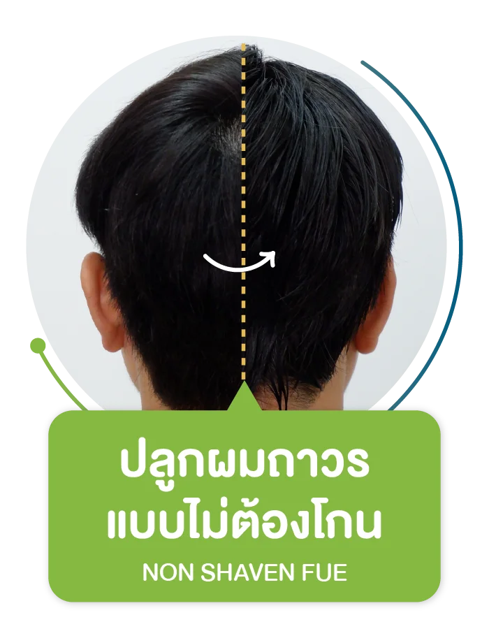ปลูกผมไม่ต้องโกน Non-Shaven FUE