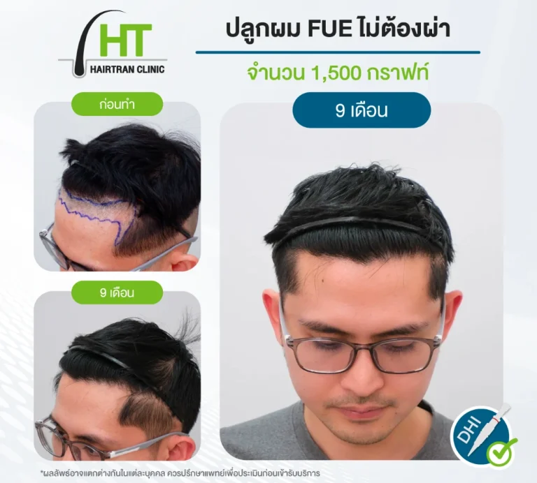 ปลูกผม FUE ไม่ต้องผ่าตัด 1500 กราฟท์