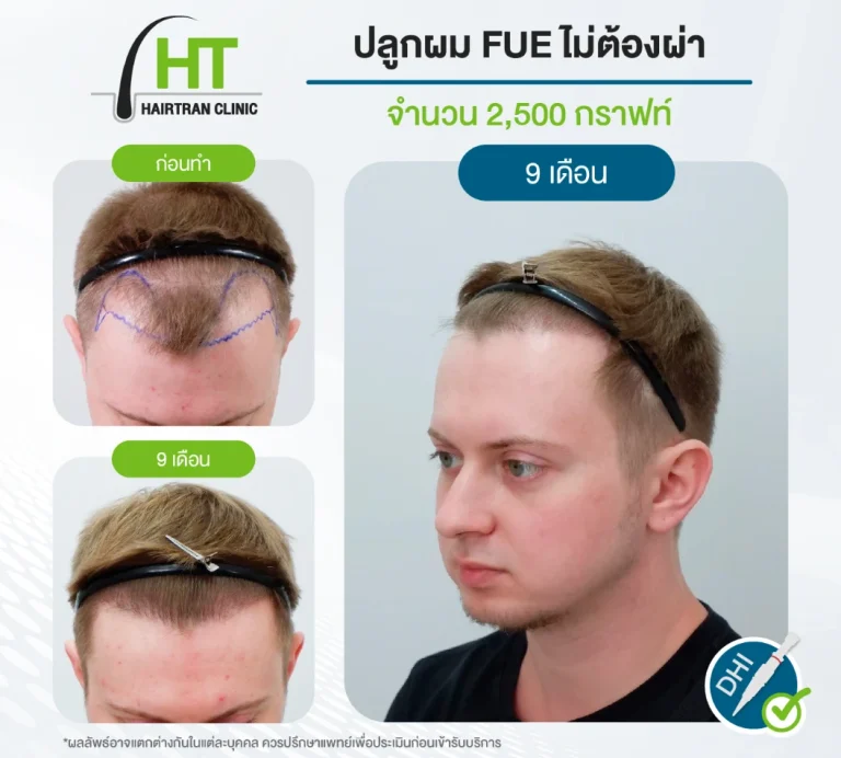 ปลูกผม FUE ไม่ต้องผ่าตัด 2500 กราฟท์