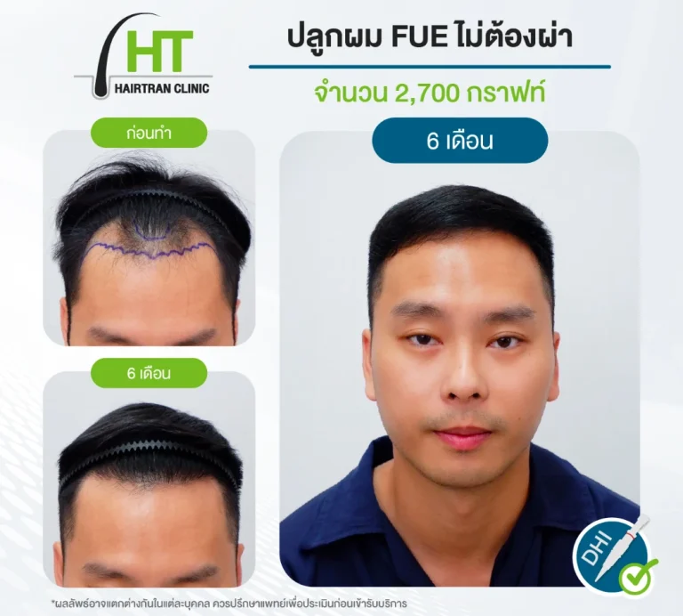 ปลูกผม FUE ไม่ต้องผ่าตัด 2700 กราฟท์