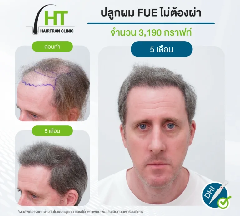 ปลูกผม FUE ไม่ต้องผ่าตัด 3190 กราฟท์