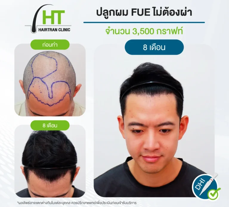 ปลูกผม FUE ไม่ต้องผ่าตัด 3500 กราฟท์
