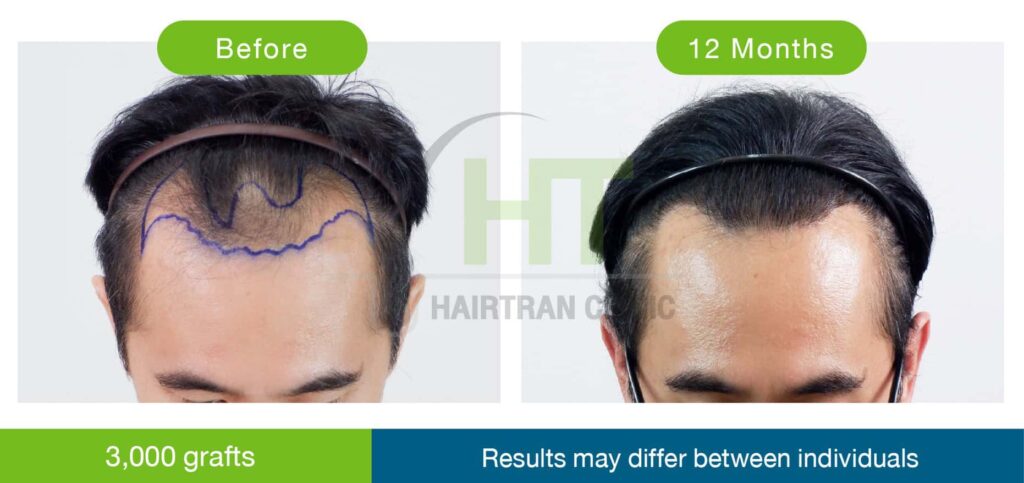 ภาพ Before/After ปลูกผม 12 เดือน 3,000 กราฟท์