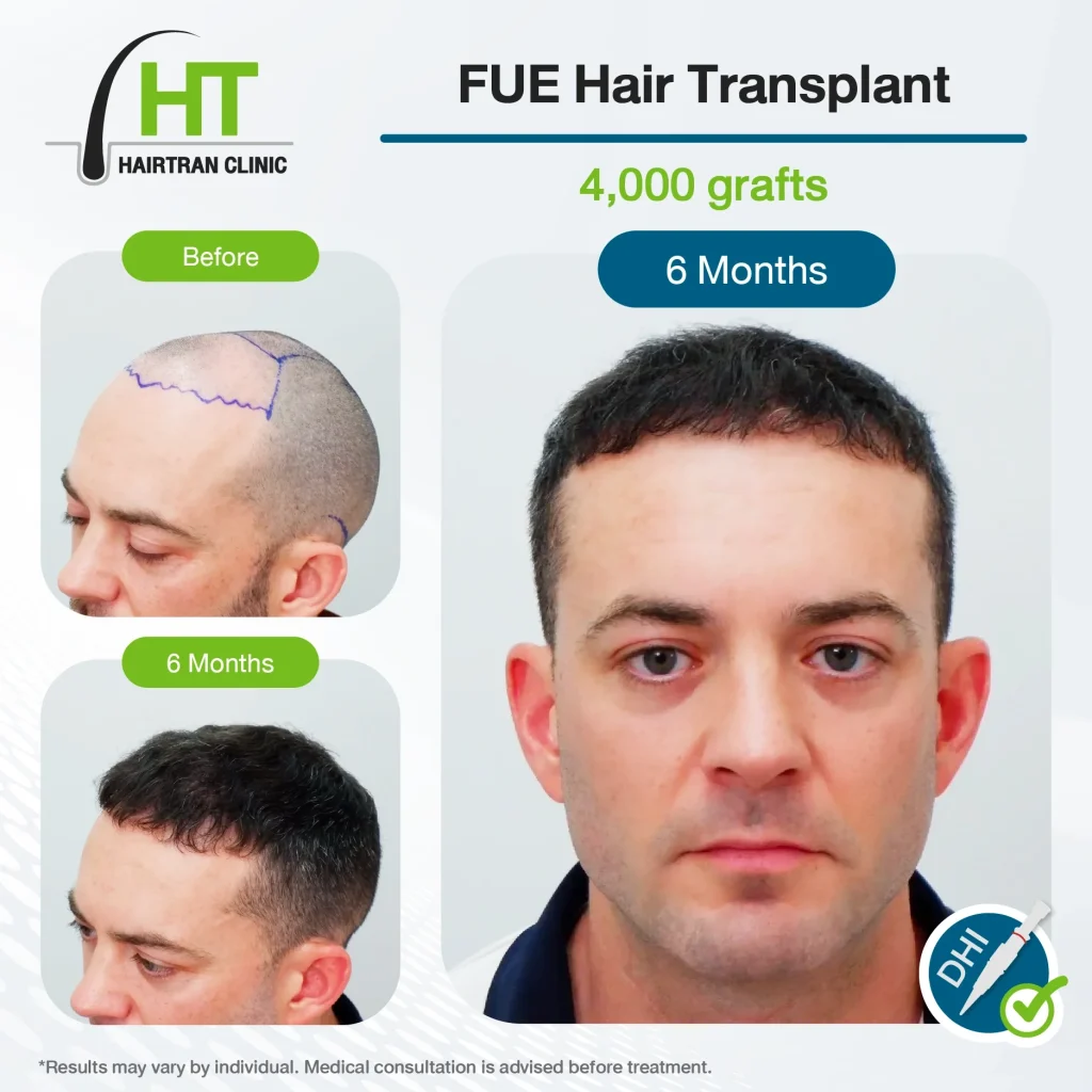 FUE Hair Transplant Review 6 Months 4,000 Grafts
