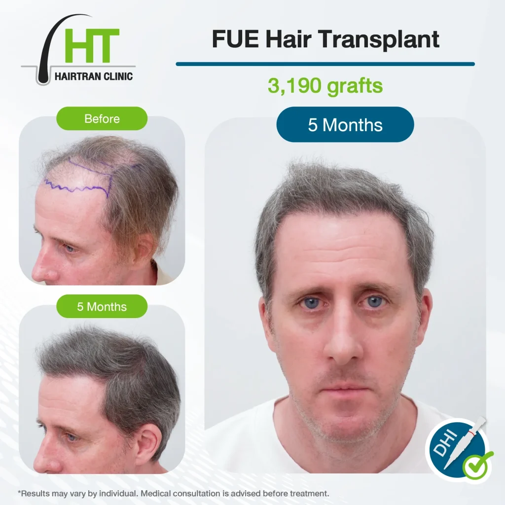 FUE Hair Transplant Review 5 Months 3,190 Grafts