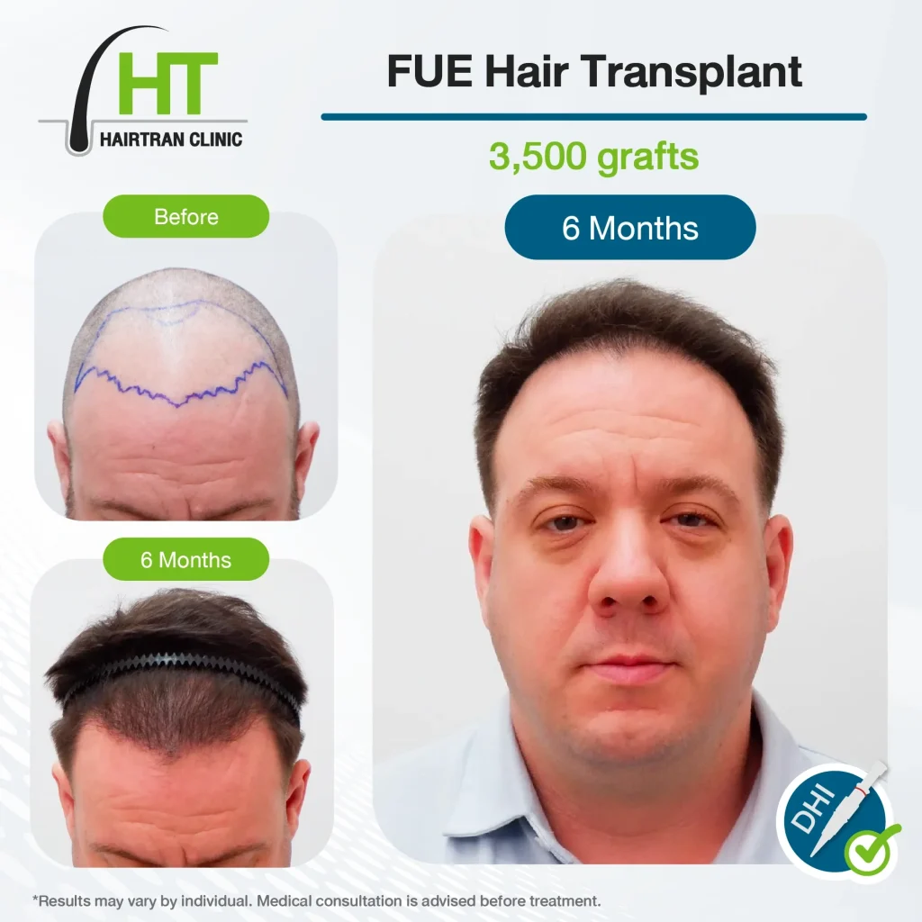 FUE Hair Transplant Review 6 Month 3,500 Grafts