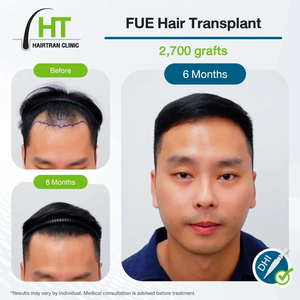 FUE Hair Transplant Review 6 Months 2,700 Grafts