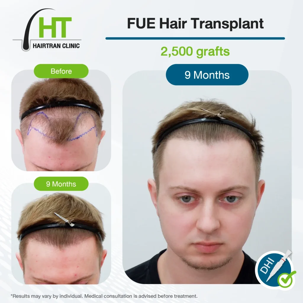 FUE Hair Transplant Review 9 Months 2,500 Grafts