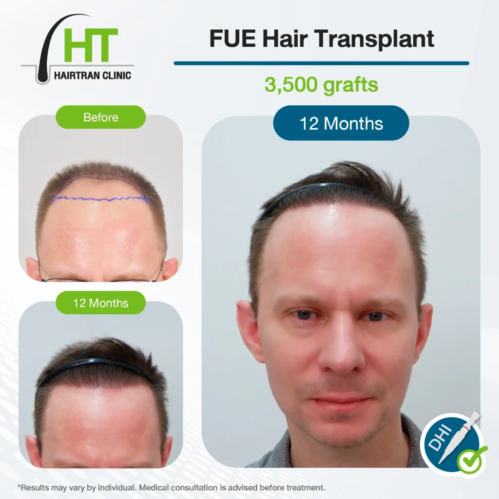 FUE Hair Transplant Review 12 Months 3,500 Grafts