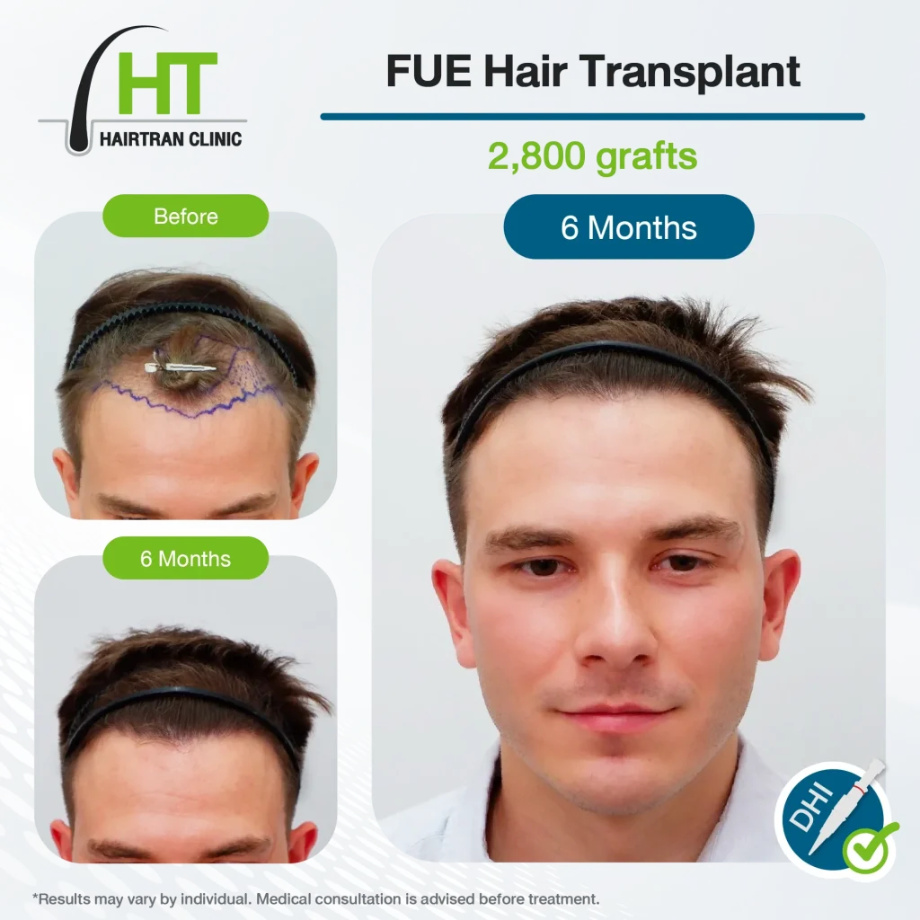 FUE Hair Transplant Review 6 Month 2,800 Grafts