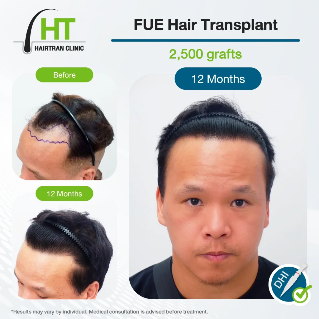 FUE Hair Transplant Review 12 Months 2,500 Grafts