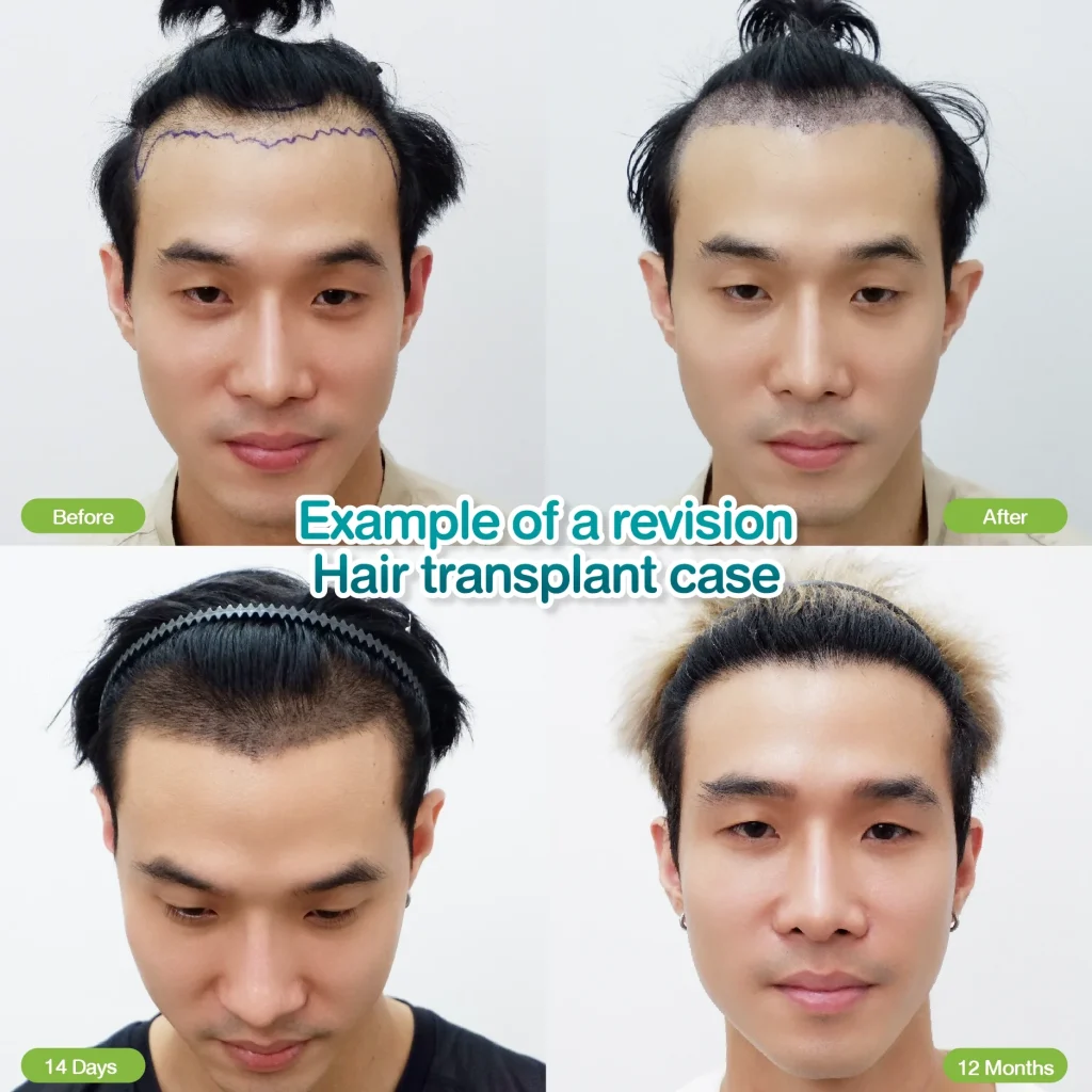 Correcting Previous Hair Transplant Results