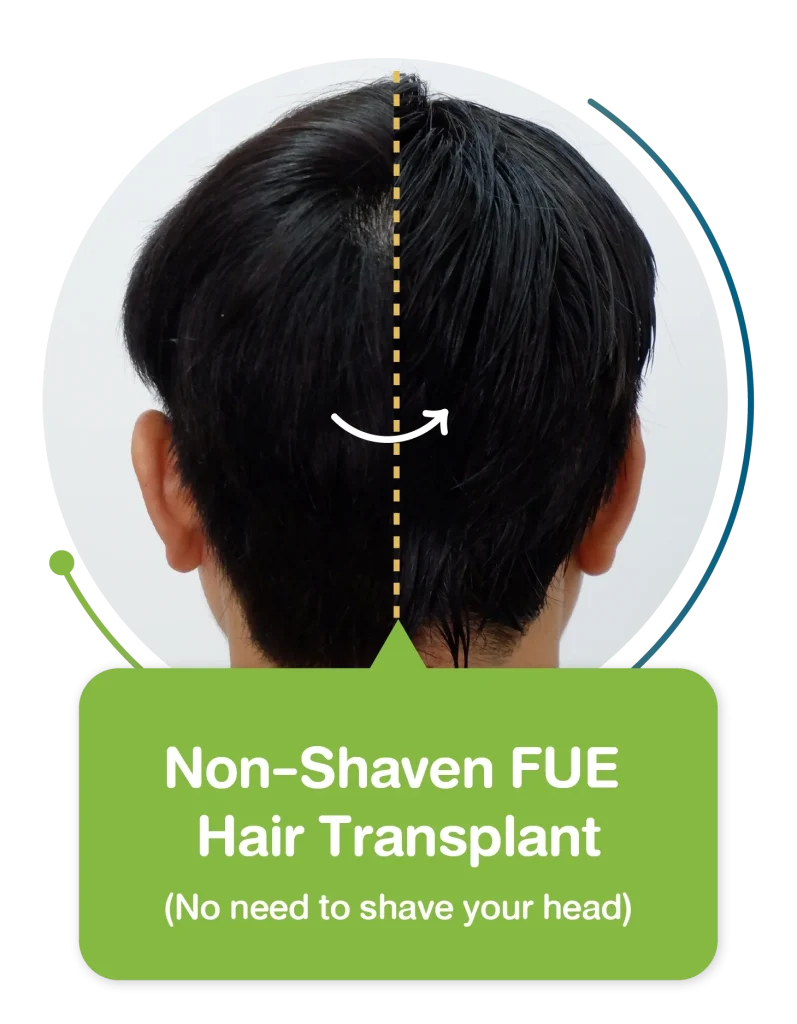 Non-Shaven FUE Hair Transplant