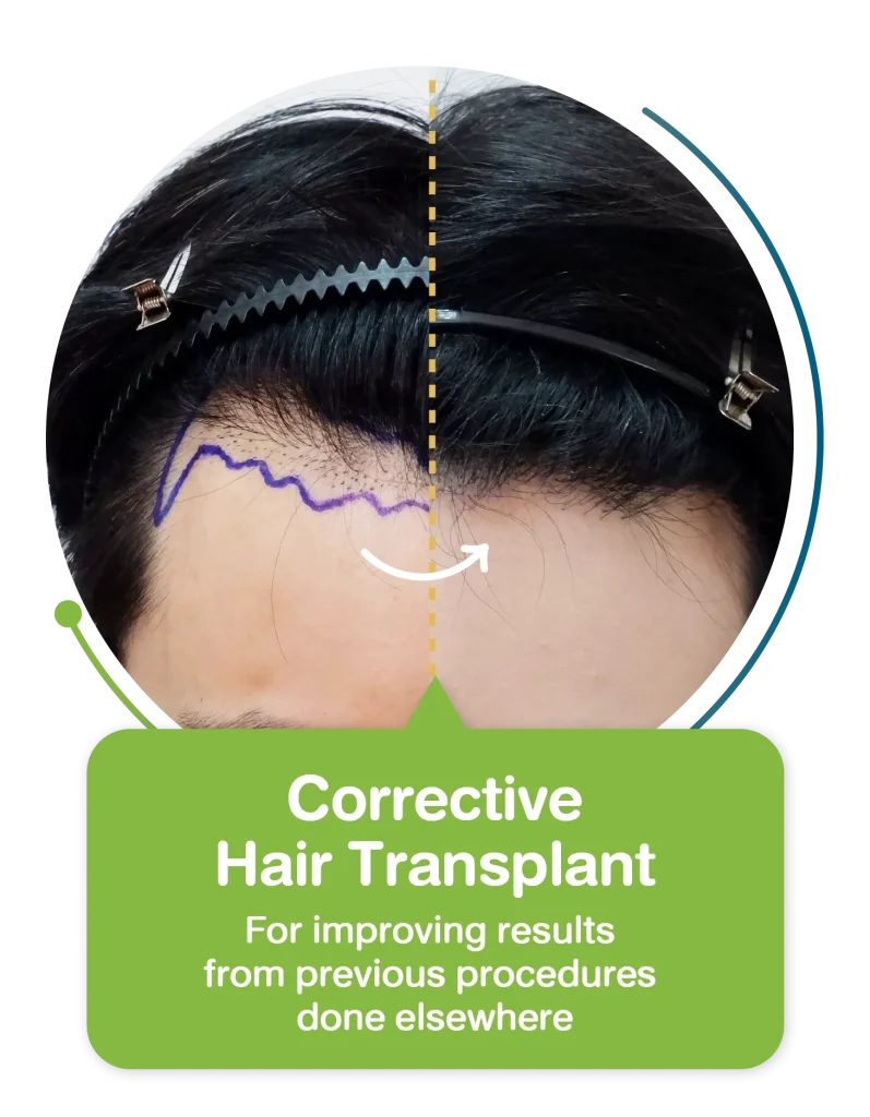 Corrective Hair Transplant