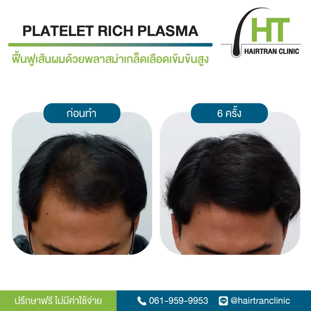 ผลลัพธ์ ฉีดเกล็ดเลือดเข้มข้น กระตุ้นรากผม 6 ครั้ง