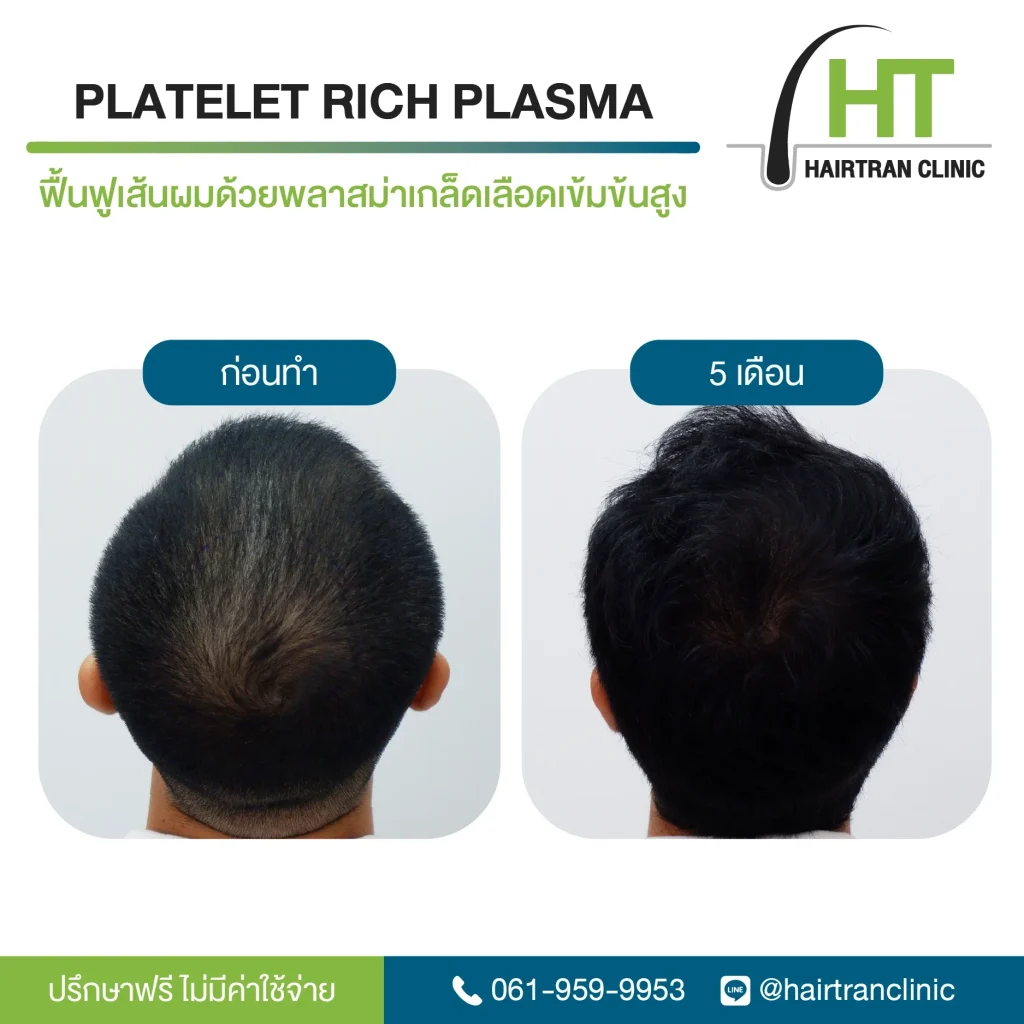 ผลลัพธ์ ฉีดเกล็ดเลือดเข้มข้น กระตุ้นรากผม 5 เดือน