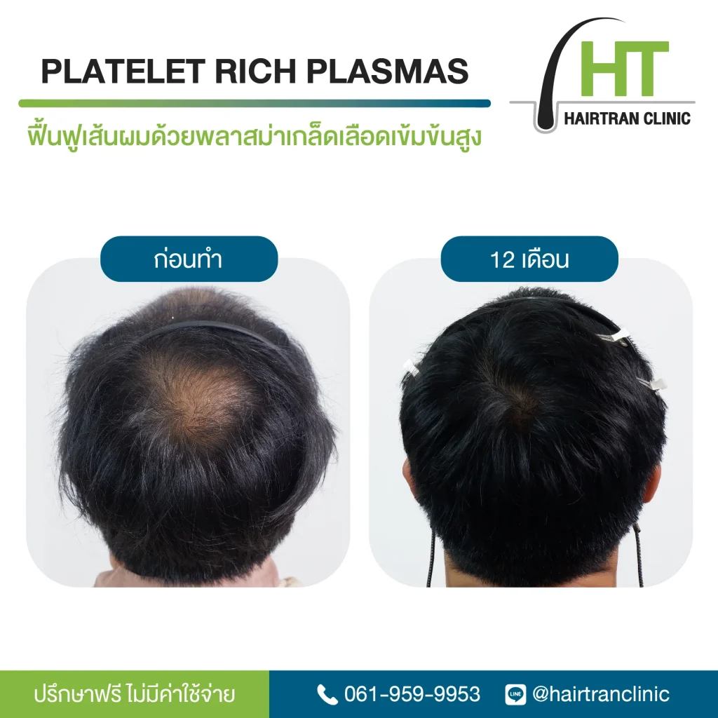 ผลลัพธ์ ฉีดเกล็ดเลือดเข้มข้น กระตุ้นรากผม 12 เดือน