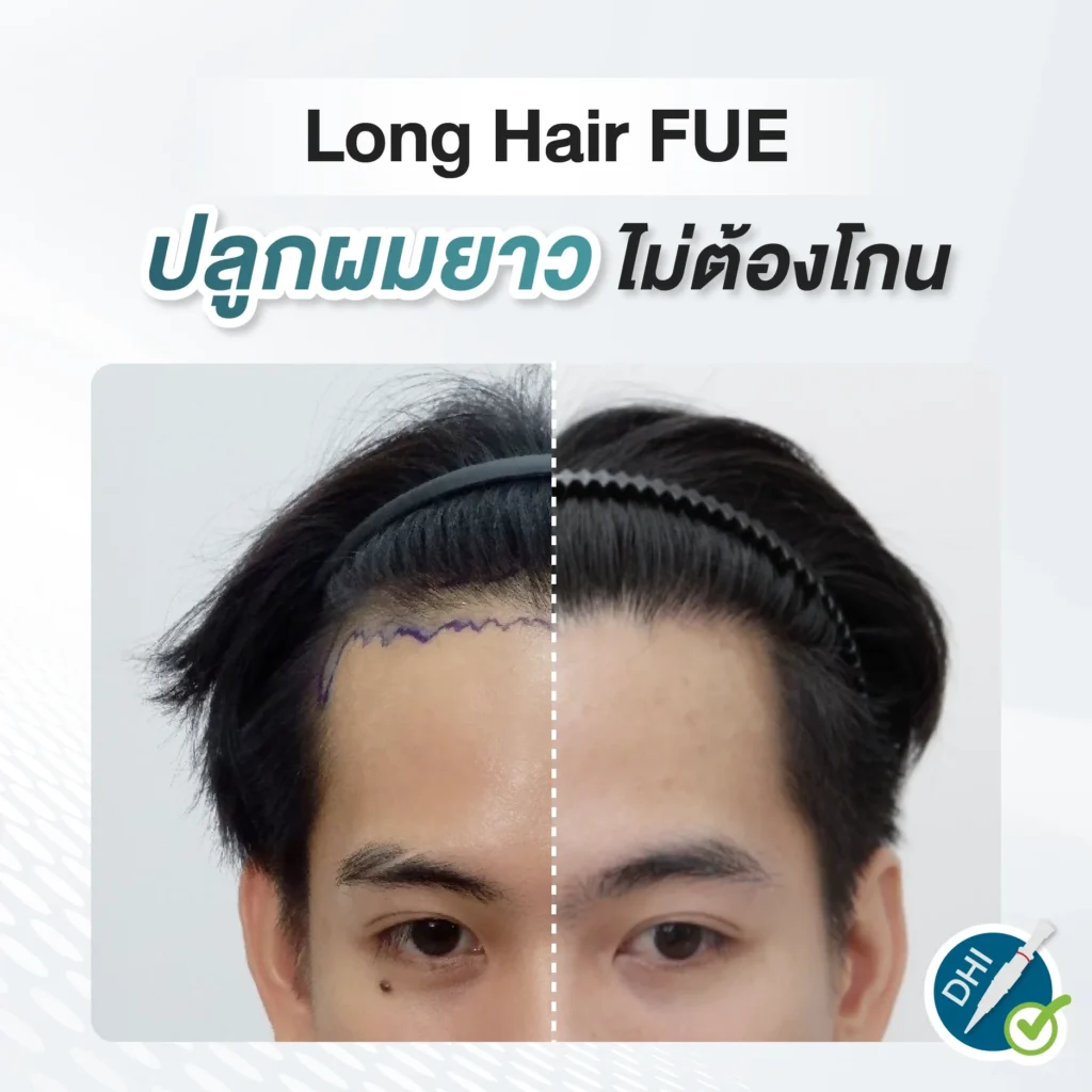 ปลูกผมยาว (Long Hair FUE) ไม่ต้องโกน