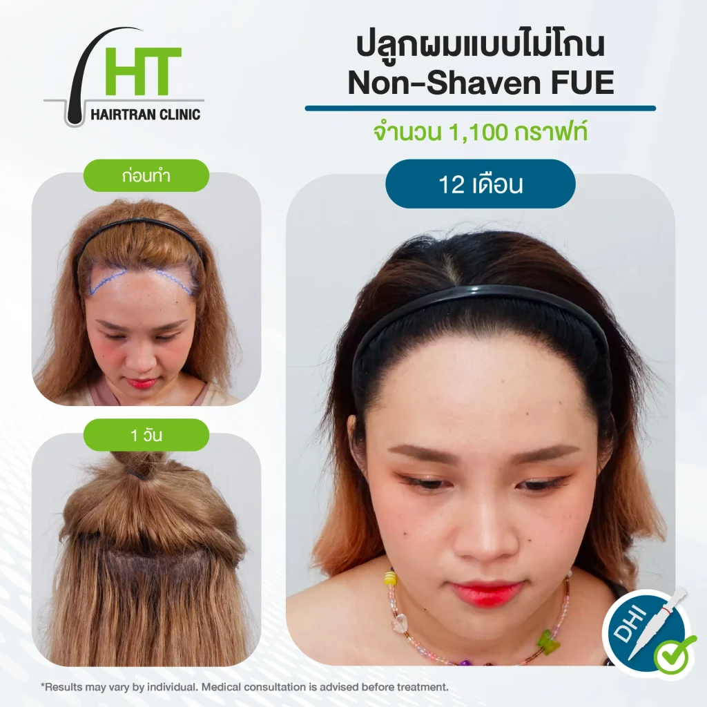 รีวิวปลูกผมไม่ต้องโกน 1,100 กราฟท์