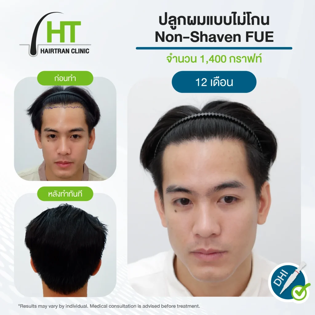 รีวิวปลูกผมไม่ต้องโกน 1,400 กราฟท์