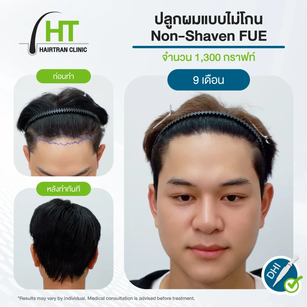 รีวิวปลูกผมไม่ต้องโกน 1,300 กราฟท์