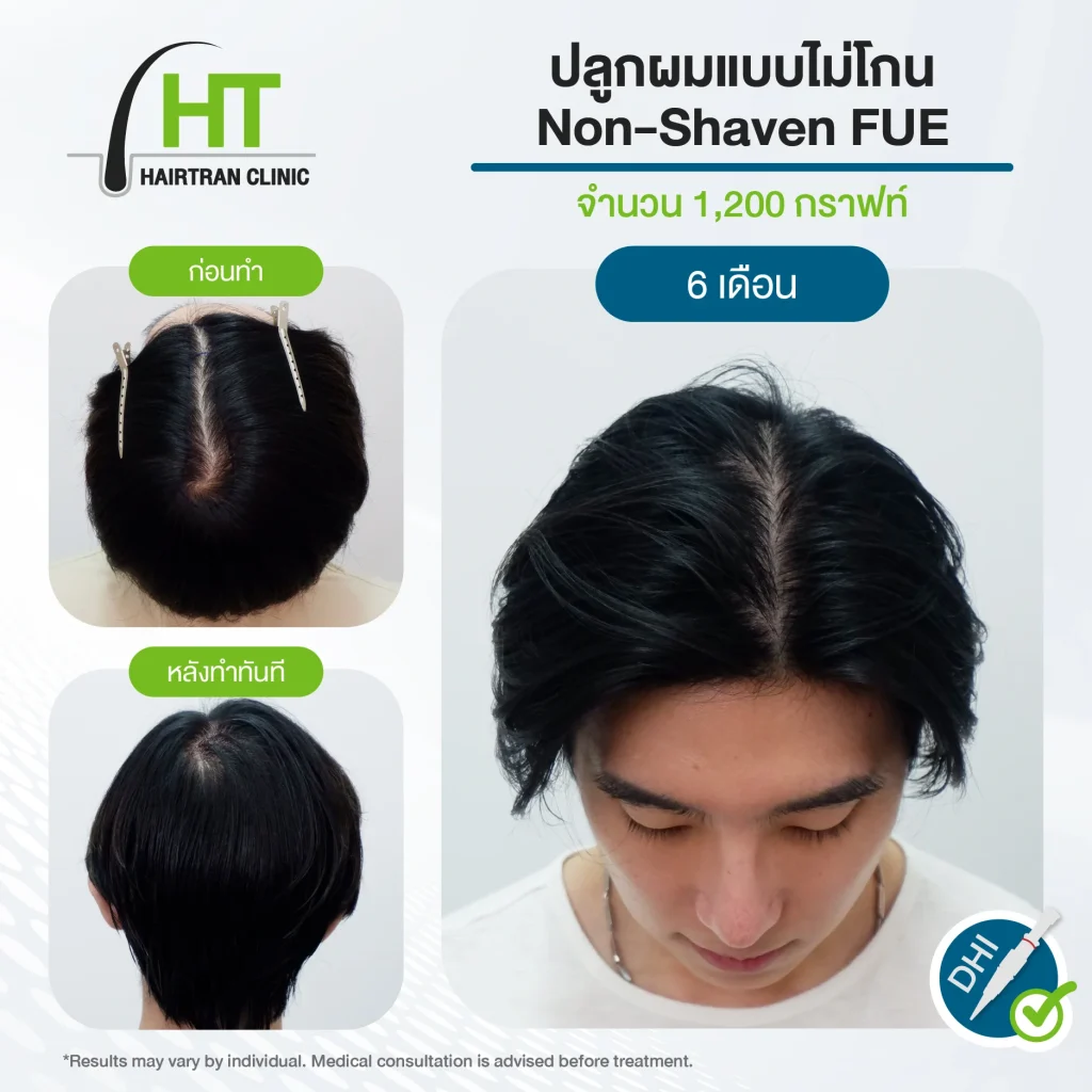 รีวิวปลูกผมไม่ต้องโกน 1,200 กราฟท์