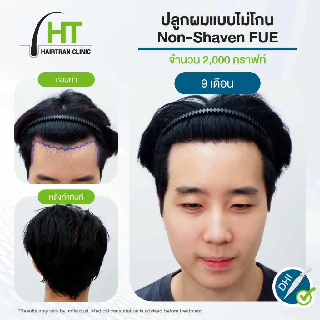 รีวิวปลูกผมไม่ต้องโกน 2,000 กราฟท์