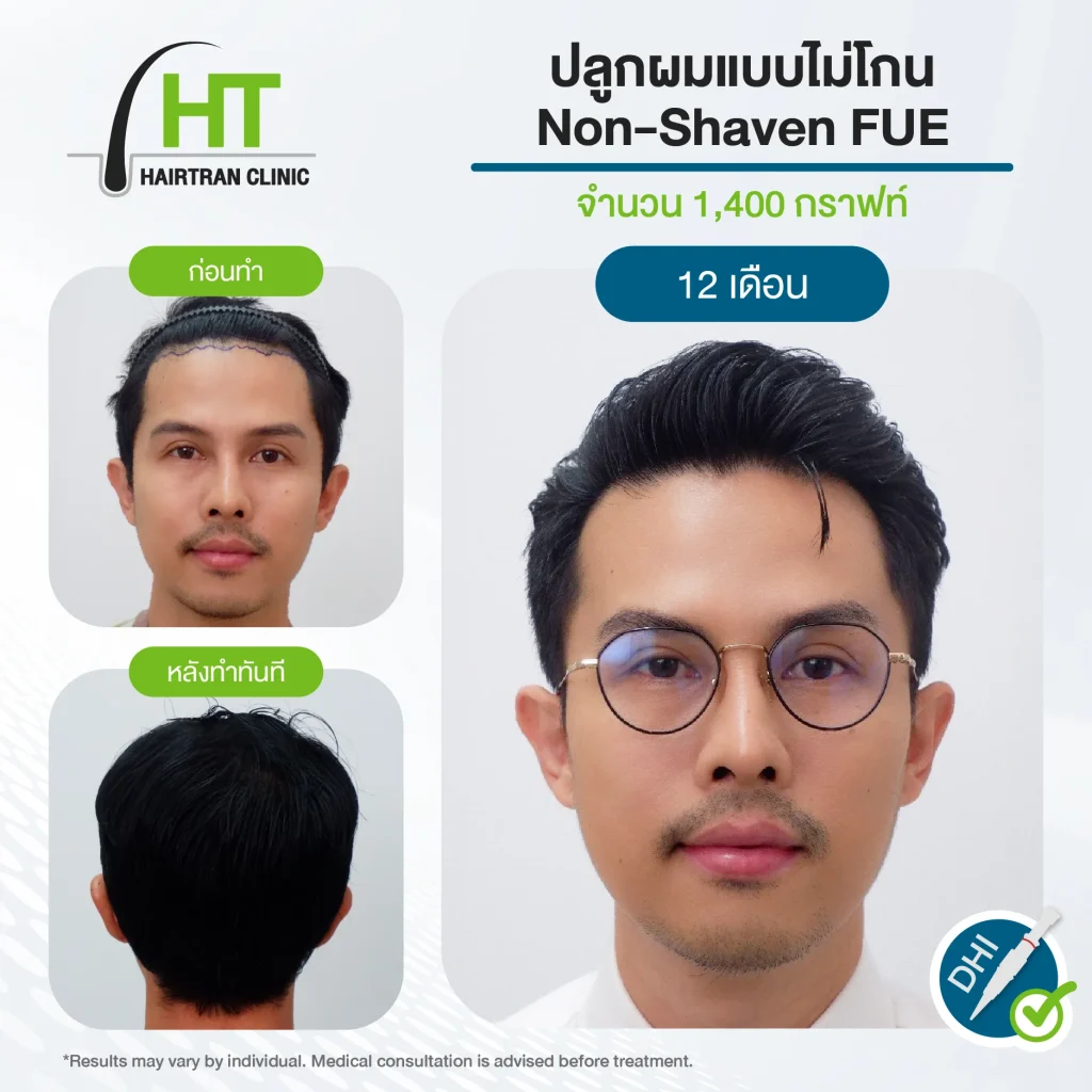 รีวิวปลูกผมไม่ต้องโกน 1,400 กราฟท์