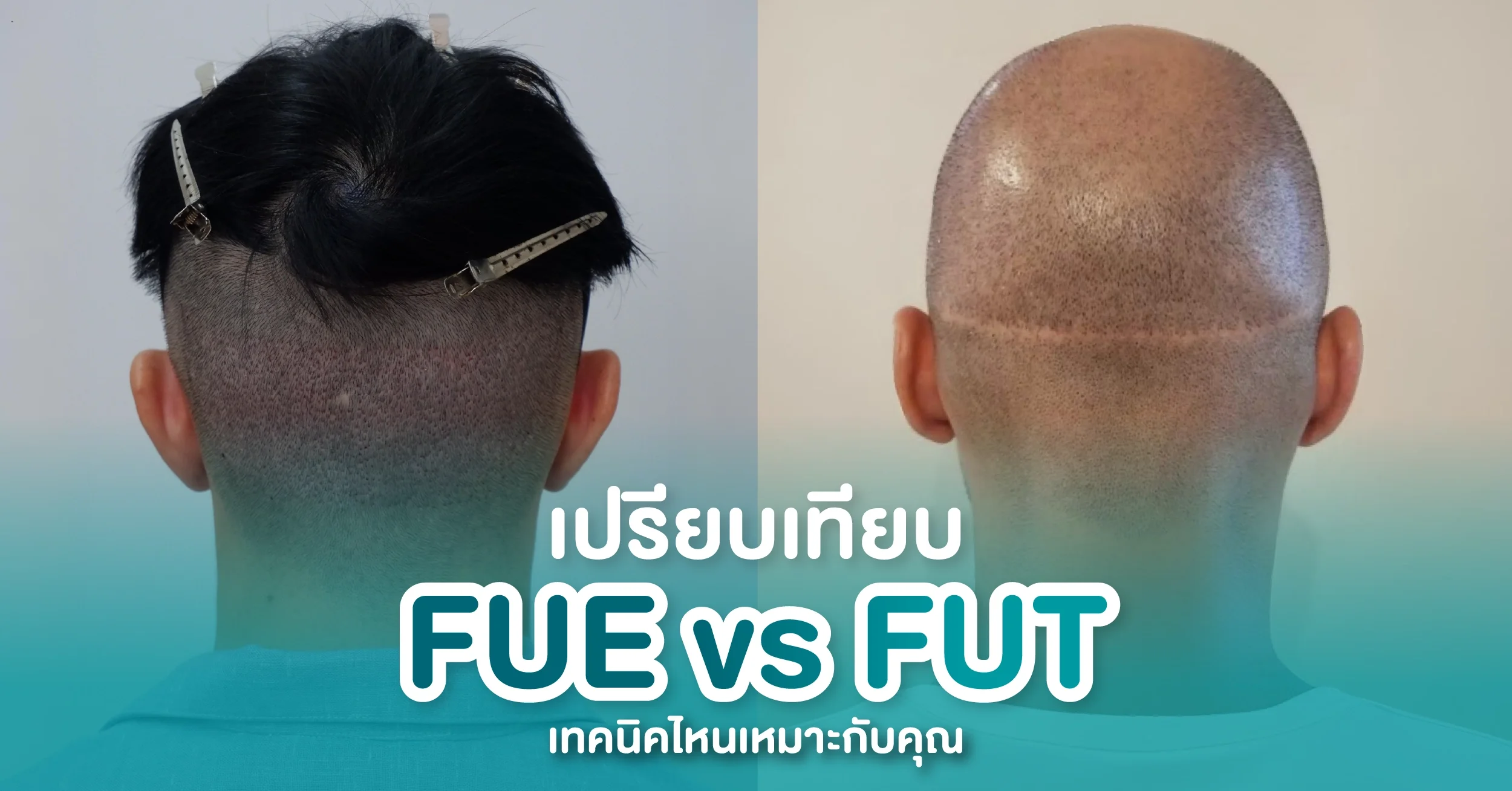 FUE vs FUT เปรียบเทียบเทคนิคปลูกผม วิธีไหนเหมาะกับคุณ?