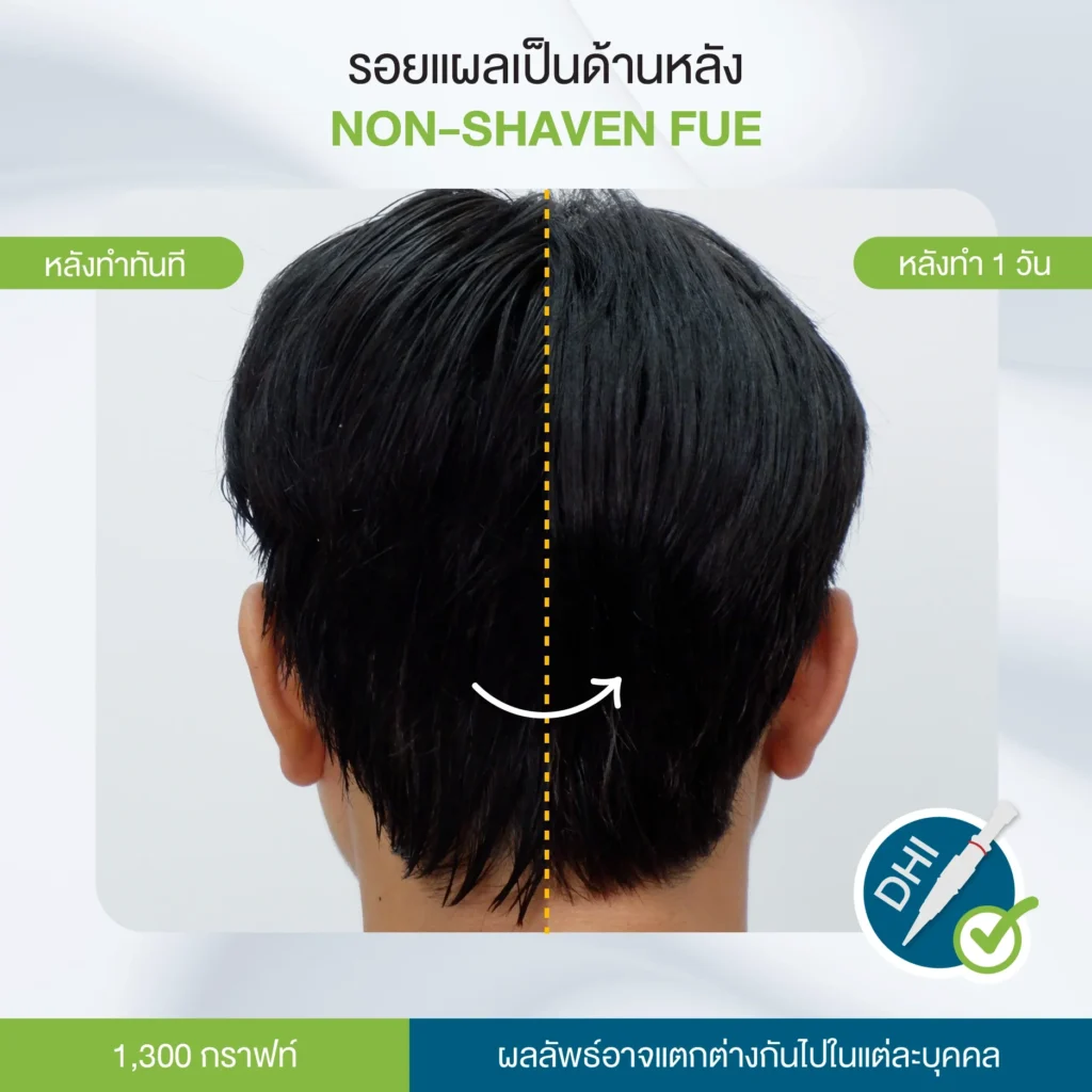 รอยแผลเป็น Non-Shaven FUE