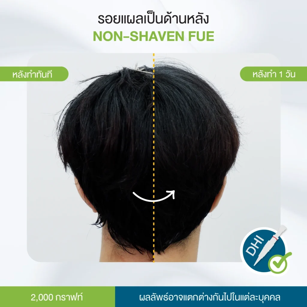 รอยแผลเป็นหลังปลูก Non-Shaven FUE