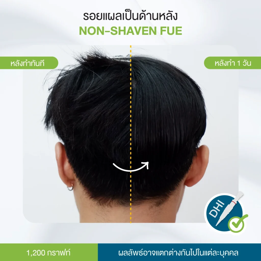 รอยแผลเป็น Non-Shaven FUE