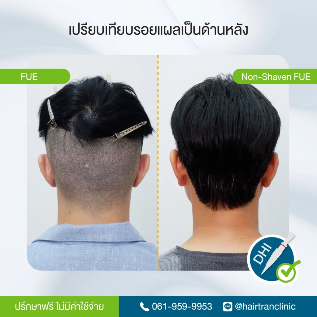 เปรียบเทียบรอยแผลเป็นหลังปลูกผม FUE และ Non-Shaven FUE