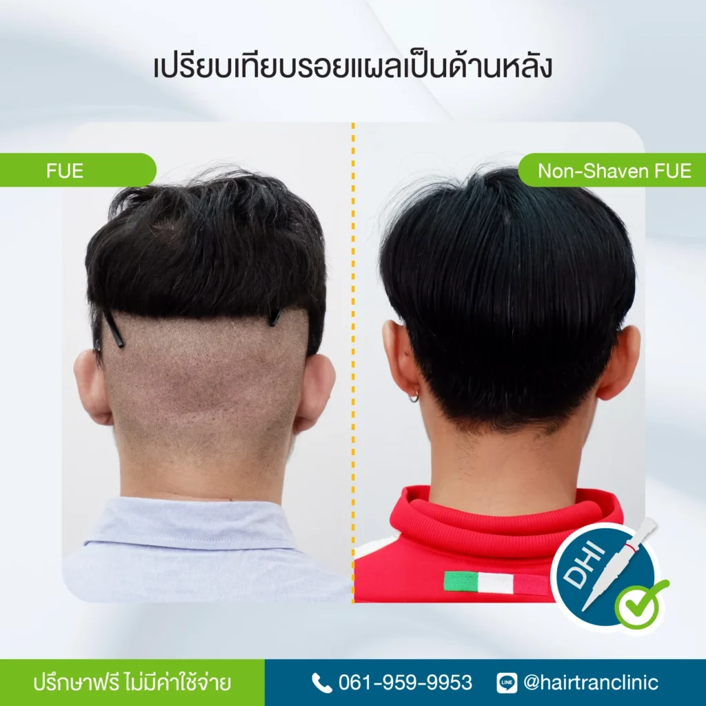 เปรียบเทียบรอยแผลเป็นหลังปลูกผม FUE และ Non-Shaven FUE