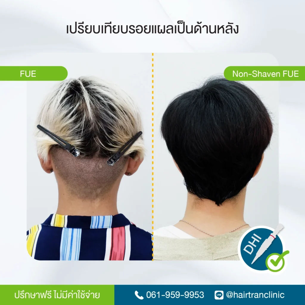 เปรียบเทียบรอยแผลหลังปลูกผม FUE และ Non-Shaven FUE