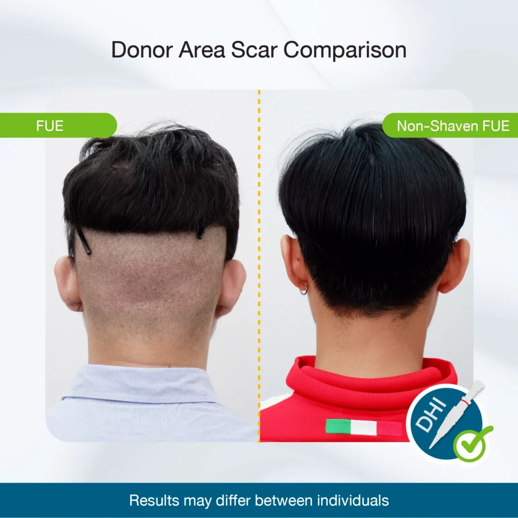 Donor-Area Scar Comparison
