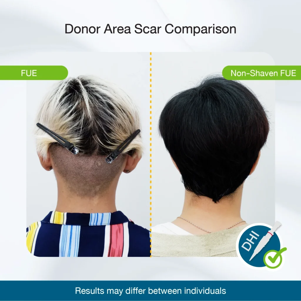 Donor-Area Scar Comparison