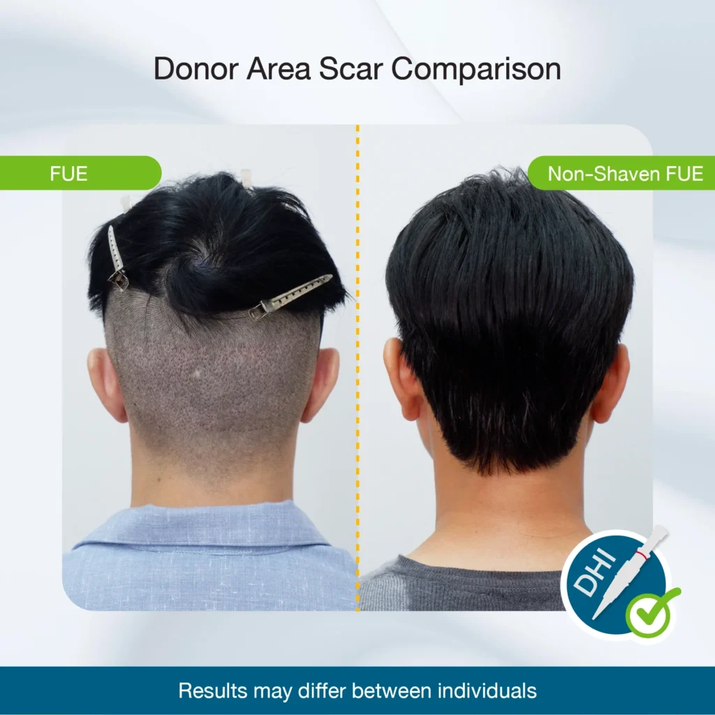 Non-Shaven vs FUE Donor-Area Scar