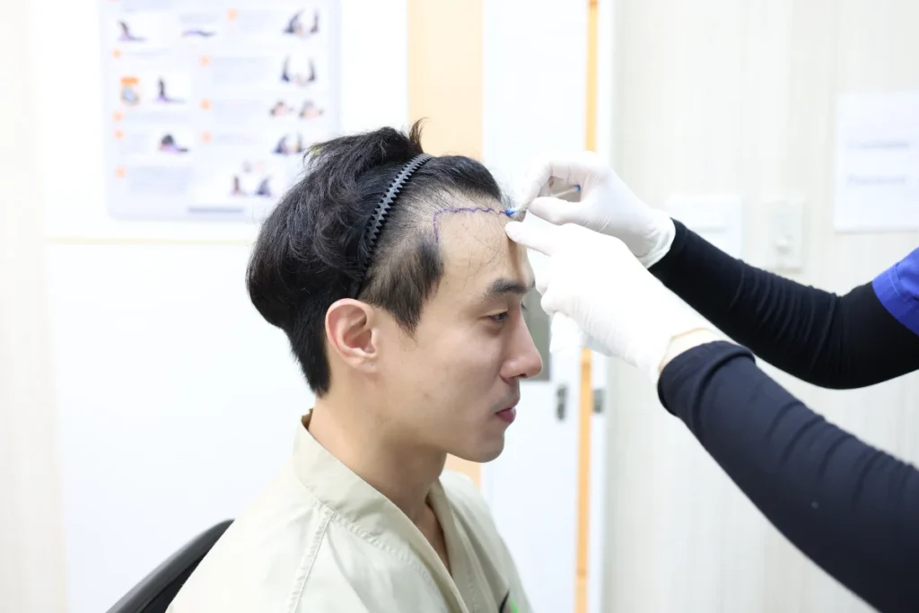 ออกแบบแนวไรผม ปลูกผม Non-Shaven FUE