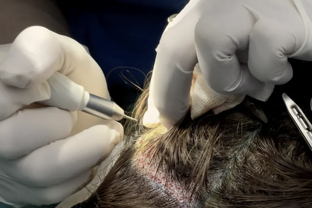 เก็บรากผมจาก Donor Area ปลูกผมแบบไม่ต้องโกน