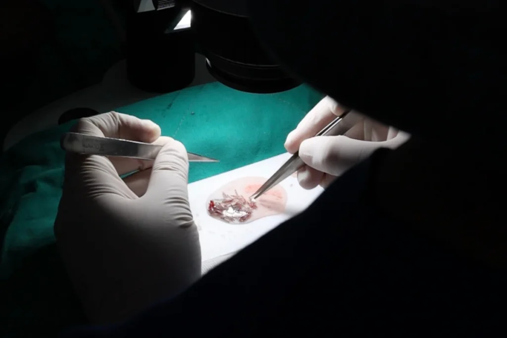 คัดกราฟท์ ขั้นตอนปลูกผม Non-Shaven FUE