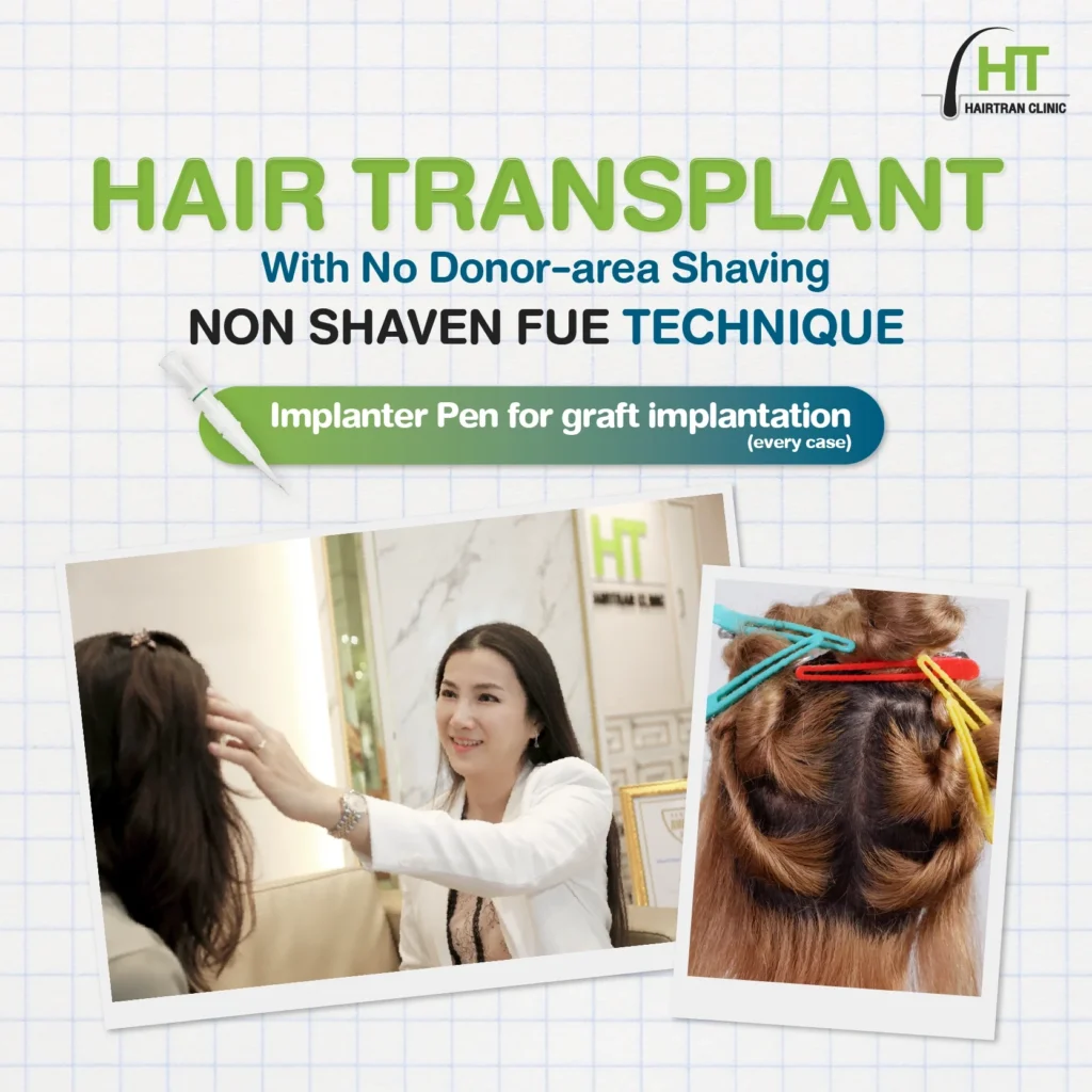 Non-Shaven Hair transplant