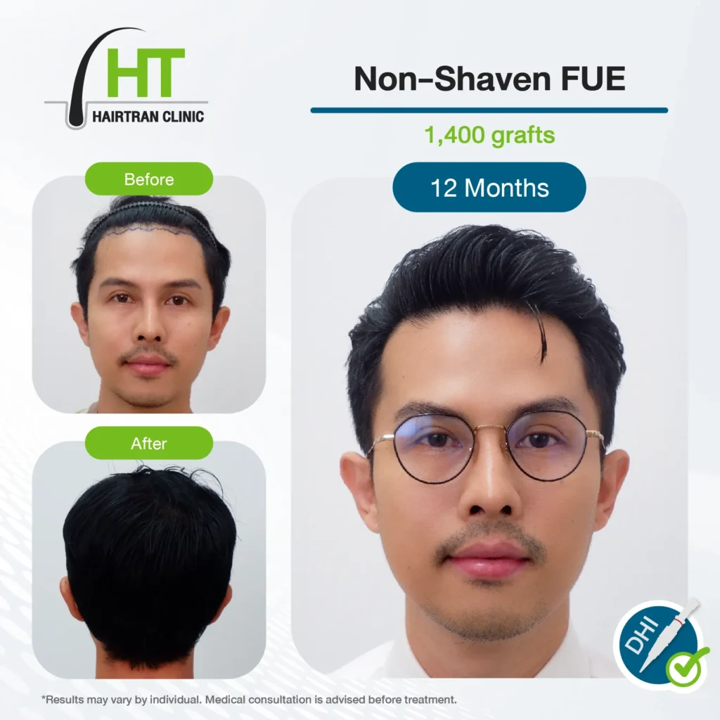 Non-Shaven FUE Hair Transplant Results