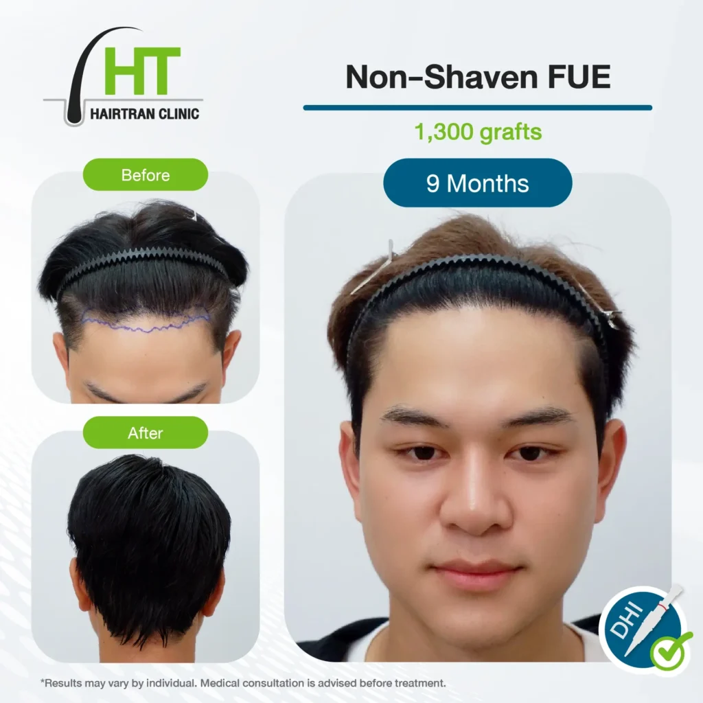 Non-Shaven FUE Hair Transplant Results