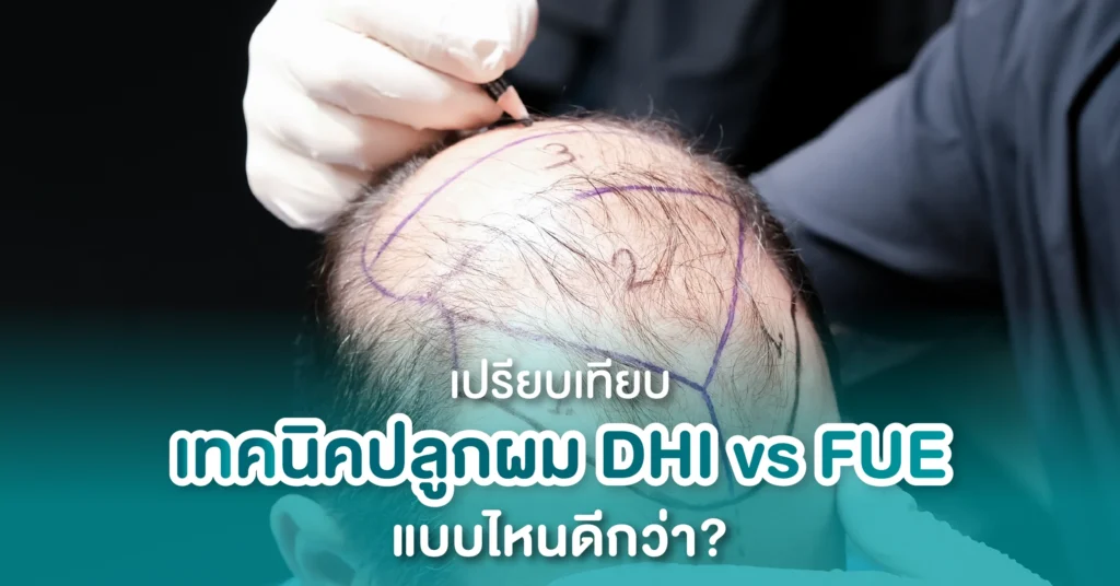เปรียบเทียบเทคนิคปลูกผม DHI vs FUE