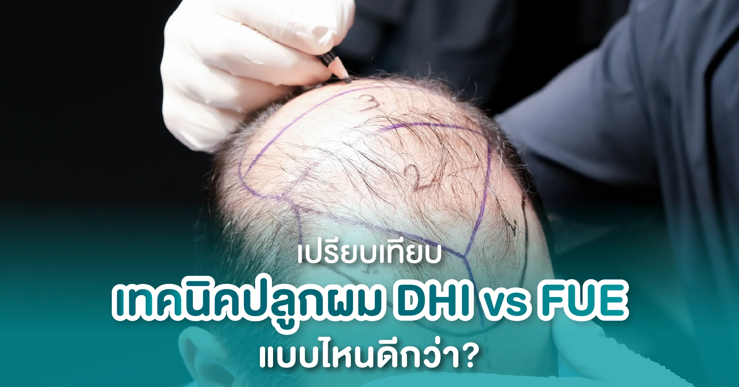 DHI vs FUE เปรียบเทียบเทคนิคปลูกผม แบบไหนดีกว่า?
